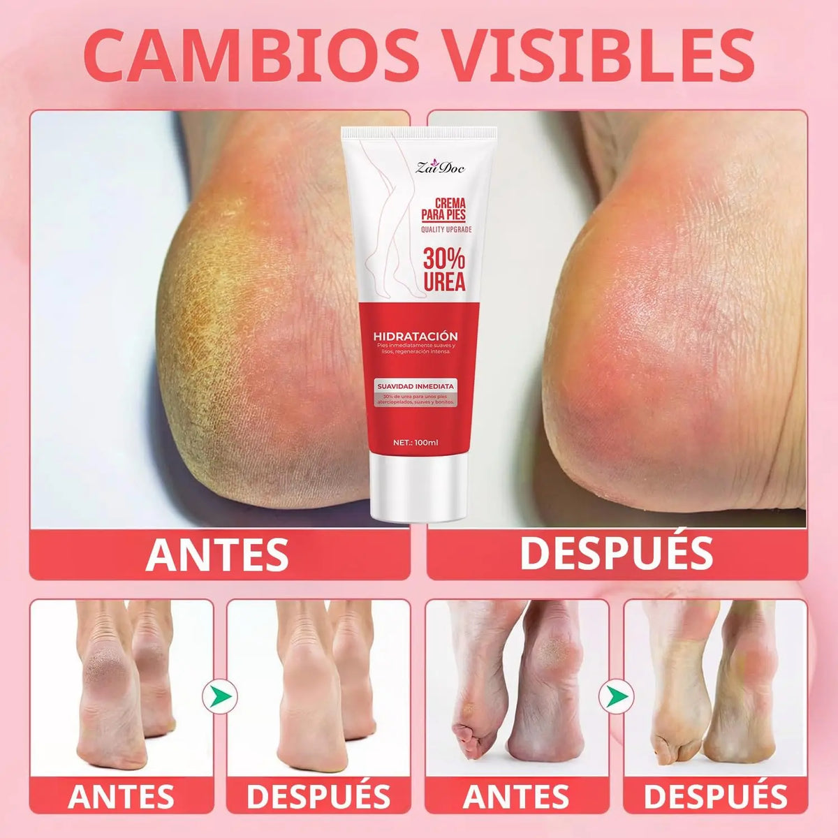 Urea Foot Cream 100ml – Moisturizing Heel Balm for Dry Feet