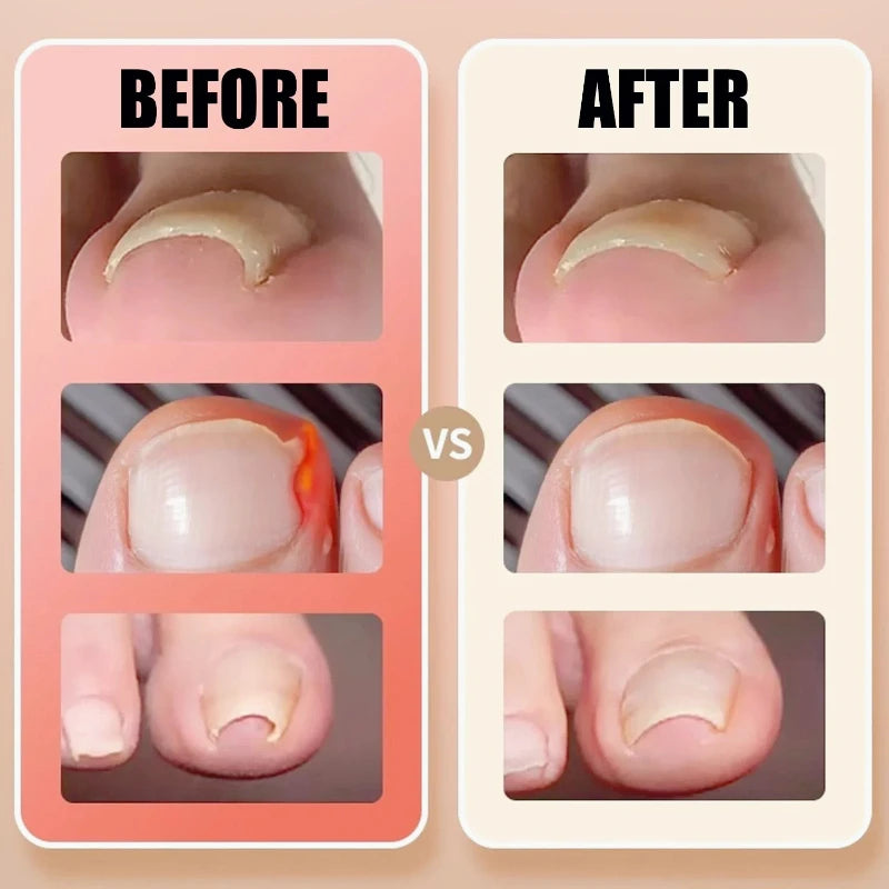 Toenail Correction Strips – Waterproof Elastic Nail Stickers