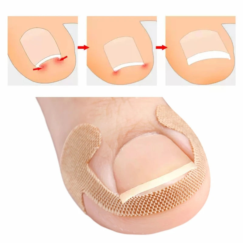 Toenail Correction Strips – Waterproof Elastic Nail Stickers