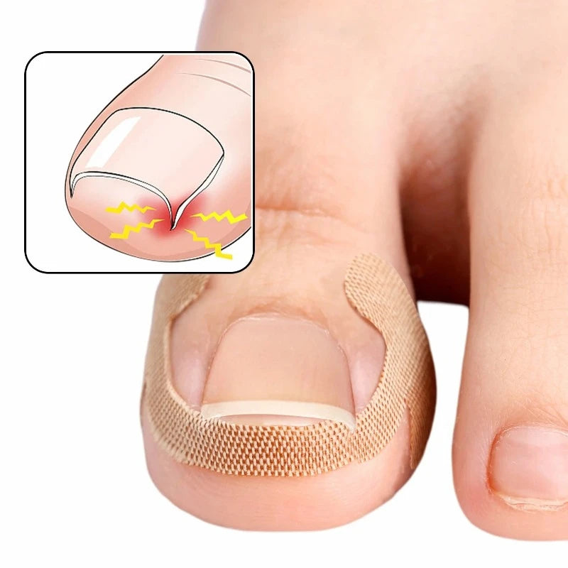 Toenail Correction Strips – Waterproof Elastic Nail Stickers