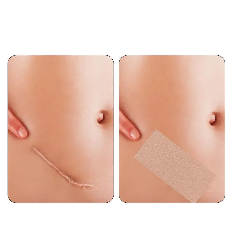 Skin Tone Concealer Patches – Hypoallergenic Cover-Up Stickers